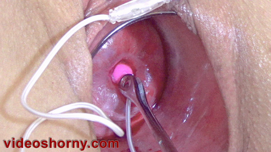 best of Pull inflation hole catheter inside